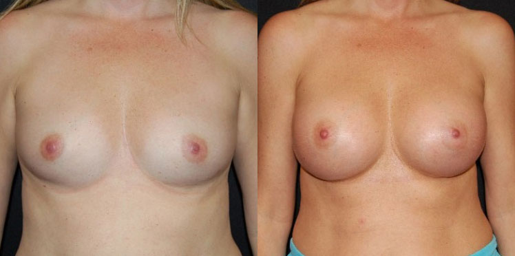 Breast Augmentation Patient Before & After
