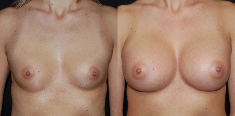 Breast Augmentation Patient Before & After 2