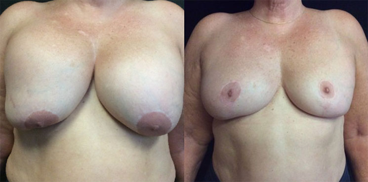 Breast Revision Actual Patient Before & After