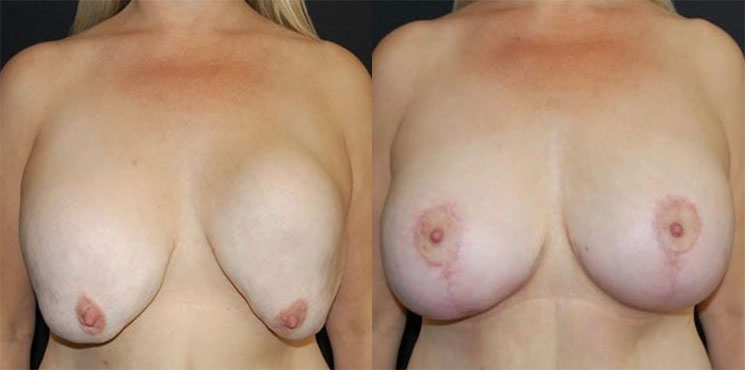 Breast Revision Actual Patient Before & After 2