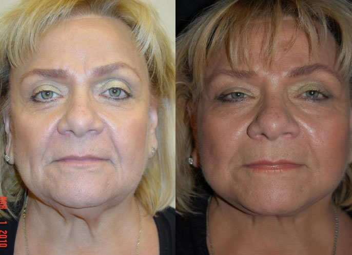 Facelift Actual Patient Before & After