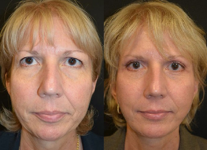 Facelift Actual Patient Before & After 2