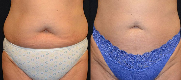 Liposuction Actual Patient Before & After