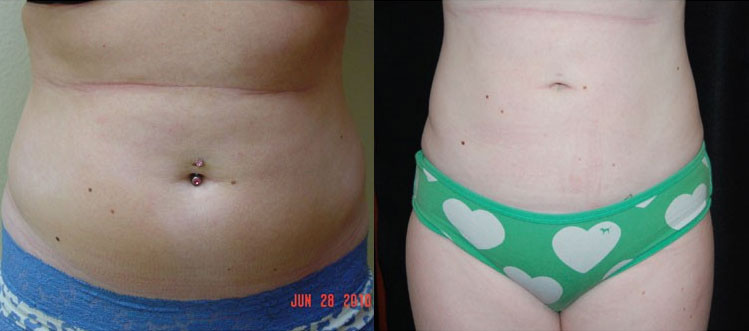 Liposuction Actual Patient Before & After 2