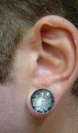 Gauge Torn Earlobe Repair San Diego CA