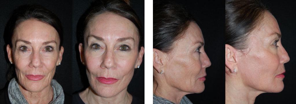 Short Scar Facelift Del Mar, San Diego