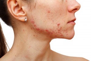 acne treatment san diego