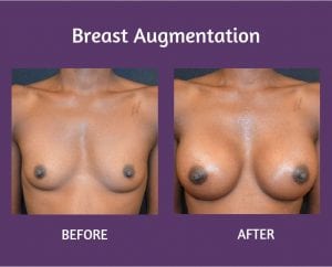 img-blog-breastaug-before16-after16-blog2