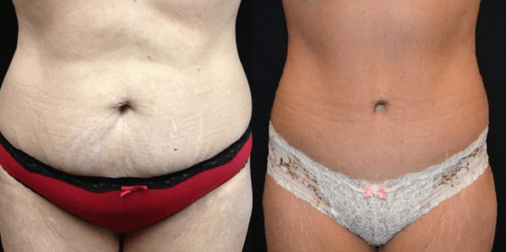 TUMMY TUCK FAQ's