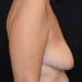 Breast Lift 1 Before - 2 Patient