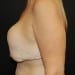 Breast Lift 5 Before - 2 Patient