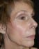 Facelift 5 Before Patient