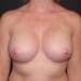 Breast Augmentation 10 After Patient