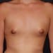 Breast Augmentation 11 Before Patient
