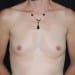 Breast Augmentation 2 Before Patient