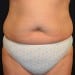 Liposuction 1 Before Patient