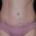 Tummy Tuck 3 After Patient