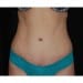 Tummy Tuck 4 After Patient