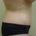 Tummy Tuck 6 After - 2 Patient