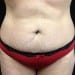 Tummy Tuck 1 Before Patient