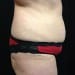 Tummy Tuck 1 Before - 2 Patient
