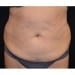 Tummy Tuck 2 Before Patient