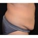 Tummy Tuck 2 Before - 2 Patient