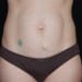 Tummy Tuck 3 Before Patient