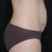 Tummy Tuck 3 Before - 2 Patient