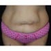 Tummy Tuck 6 Before Patient