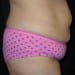 Tummy Tuck 6 Before - 2 Patient