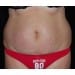 Tummy Tuck 7 Before Patient