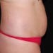 Tummy Tuck 7 Before - 2 Patient