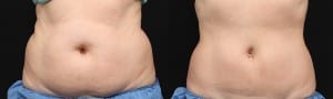 coolsculpting before and after photos