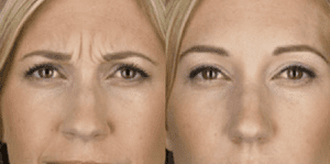 BOTOX® Cosmetic Before and After Photos