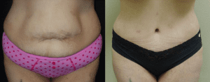 before-and-after-tummy-tuck-surgery