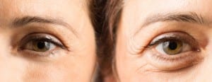 eyes-with-and-without-crows-feet