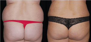 Before and After Liposuction