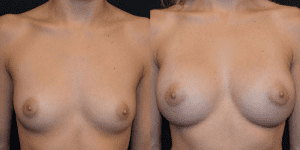 Before and After Breast Implants