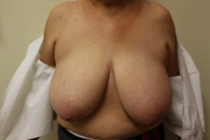 Breast Reduction patient