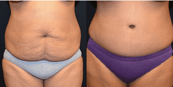 Tummy Tuck Recovery