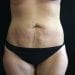 Tummy Tuck 21 Before Patient