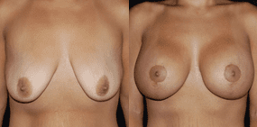 Breast Lift Before and After Photos