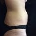 Tummy Tuck 21 Before - 2 Patient