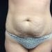 Tummy Tuck 22 Before Patient