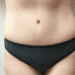 Tummy Tuck 22 After Patient