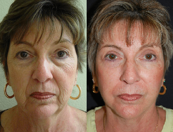 Facelift 6before6aafter6a-img-blog