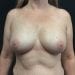 Breast Augmentation 25 After Patient