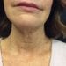 Facelift 9 Before - 2 Patient