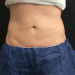 Coolsculpting 1 Before Patient